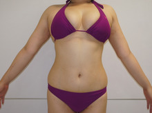 【32歳女性】他院下腹部脂肪吸引後　腹部腰部+上・下背部ベイザー脂肪吸引　2【3か月】