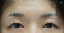 39歳女性　まぶたのたるみが強く加齢を感じさせる顔貌のセミプレミアムクイック