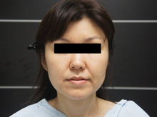 38歳　頬・アゴ下VASER脂肪吸引+ほうれい線脂肪注入ですっきり+若返り(≡^∇^≡)1