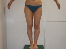 【他院術後】31歳女性 ベイザー脂肪吸引（太もも・臀部・膝周り）　153㎝49ｋｇ