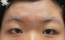とてもまぶたが厚くて脂肪除去が望ましい方の二重手術。