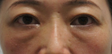 45歳女性。切らない目の下の若返り治療。シワが少しあっても効果あり(≡^∇^≡)