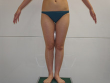 28歳女性のベイザー太もも・お尻・膝周り脂肪吸引　3　8か月　154㎝49㎏