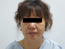 【50歳女性】シグネチャーリフト+頬・アゴ脂肪吸引+中顔面・ほうれい線脂肪注入2　8か月
