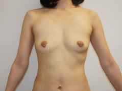 40歳女性　太もも・お尻・膝周りVASER脂肪吸引＆CRF豊胸　3