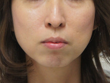 小顔ボツリヌストキシン注射で面長美人に