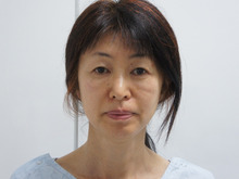 52歳女性（他院術後）　シグネチャーリフト+頬・アゴ下脂肪吸引+中顔面・ほうれい線脂注　2
