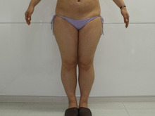 162㎝81㎏29歳　すごく太い大腿・臀部膝周りをベイザーで2回に分けて脂肪吸引　　1