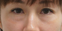40歳女性　目の下のたるみ（クマ）を皮膚を切らずにダウンタイム短く改善