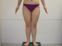 20歳女性　155㎝53㎏とても太い太ももをベイザーで美脚へ　　1　ダウンタイム