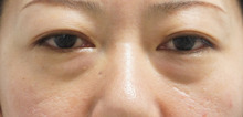 43歳女性　目の下のたるみ（クマ）を皮膚を切らずにダウンタイム短く改善