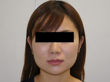 25歳女性　頬・アゴ下VASER脂肪吸引