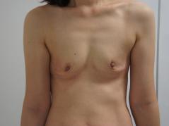 【必見！バストの若返り】43歳女性CRF豊胸　3　1年後