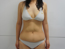 31歳女性　腹部たるみとり+腹腰・上臀VASER（+CRFバスト脂肪注入）　術後3か月