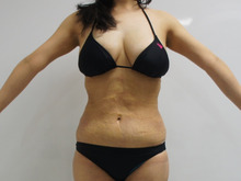 31歳女性　腹部たるみとり+腹腰・上臀VASER（+CRFバスト脂肪注入）2　ダウンタイム