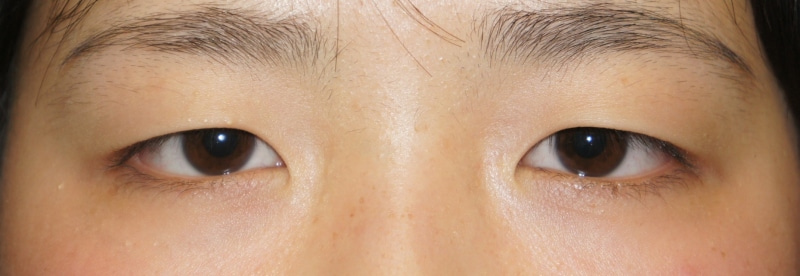 たれ目（さんかく目）に見えてしまう一重まぶたから自然な末広型二重へ【セミプレミアムクイック】
