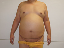 生命の危険を伴いかねない110㎏の男性の脂肪吸引　ベイザー使用　1