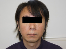 たるみが少ない46歳男性のミントリフト（フェイスラインの小顔効果）