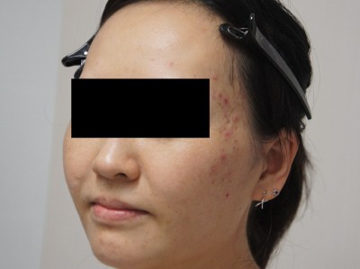 33歳女性　ニキビ治療　ロアキュタンとマーベロンだけで確実な効果を