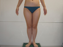 23歳女性　160㎝59㎏ベイザーによる太ももお尻膝周り脂肪吸引　3　8か月