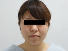20歳女性の頬・アゴ下ベイザー（VASER)脂肪吸引　1　ダウンタイム