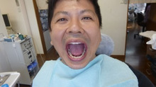 最新の歯科治療セレック（CEREC)で一日で重度の虫歯治療が終了ヾ(＠^▽^＠)ﾉ