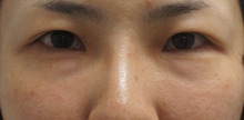 37歳女性の目の下のクマをダウンタイム少なく改善【経結膜脱脂術+除去脂肪注入】