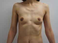 39歳女性バッグインプラント除去後CRF豊胸にて“揺れる”を実感　2