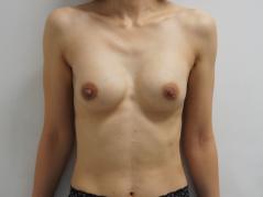 39歳女性バッグインプラント除去後CRF豊胸にて“揺れる”を実感　1