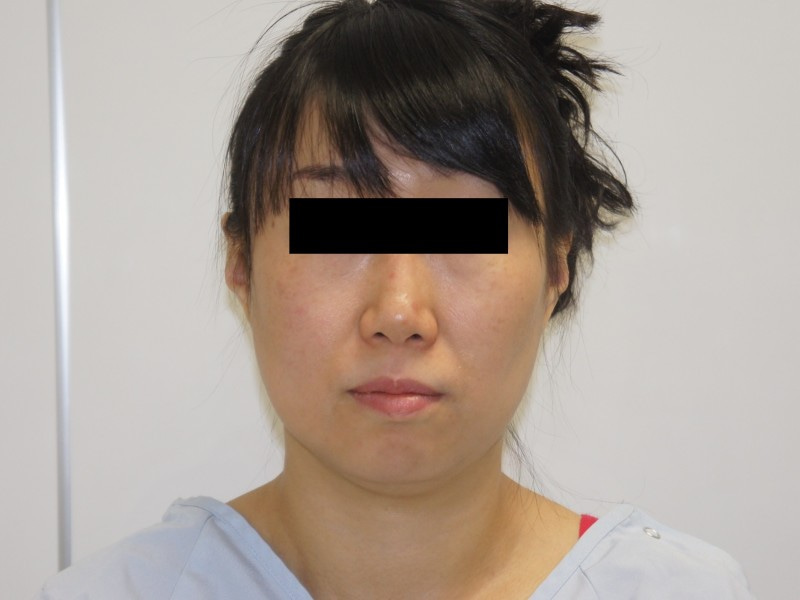42歳女性　頬・アゴ下のベイザー