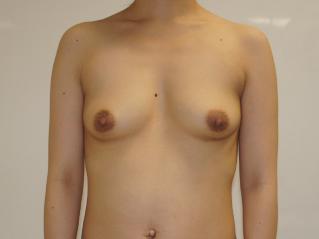 33歳女性コンデンスリッチ豊胸（腹部VASER採取）1　1年後