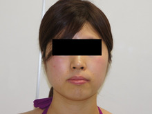 27歳女性頬とアゴ下のVASER脂肪吸引（ベイザー）でキレイなフェイスライン