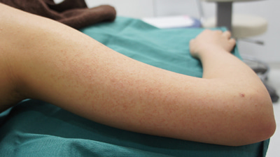 21歳女性　毛孔性苔癬治療3回　二の腕と前腕のブツブツの悩み