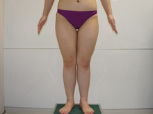 20歳女性　155㎝53㎏とても太い太ももをベイザーで美脚へ　　3　6か月後