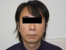 たるみが少ない46歳男性のミントリフト7か月で効果が無くなった？？
