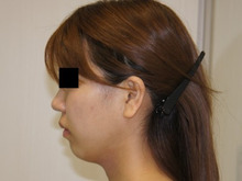 ミントリフトの小顔効果は本物か？えぇ本当です (｀・ω・´)　2（直筆感想文）