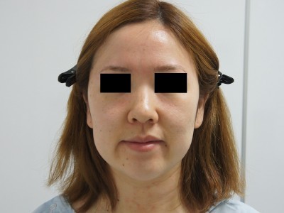 美容外科で美しくなるということ。　　　頬・アゴ下ベイザー（中顔面など脂肪注入）