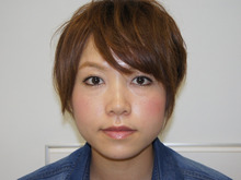 小顔注射全顔モニターの患者様