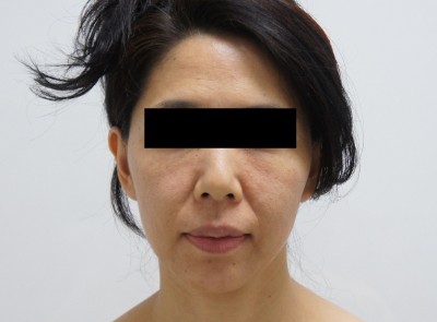 中顔面とほうれい線の大量ヒアルロン酸（10ｃｃ）で若返り　