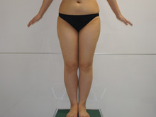 33歳157㎝56㎏　太もも・臀部・膝周り（ふくらはぎ・足首）　ベイザー脂肪吸引