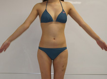 34歳女性　他院ベイザーCRF豊胸術後　ベイザー腹腰、大腿内側ベイザーCRF　3