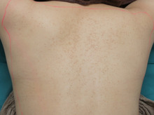 29歳女性背中の毛孔性苔癬のダーマローラー治療。　自筆感想文あり