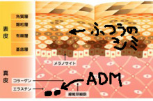 後天性真皮メラノサイトーシス（ＡＤＭ・太田母斑の仲間）7回照射後　1年