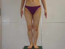 45歳　大腿・臀部・膝周りのベイザー脂肪吸引