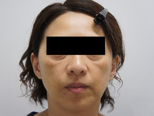 49歳女性　中顔面痩せなど顔面のボリュームロスによる加齢印象に大量ヒアルロン酸（10㏄）