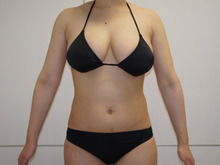 23歳女性（166㎝65㎏）ベイザー脂肪吸引でお腹周りをスッキリと
