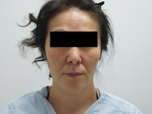 47歳女性　シンシアシグネチャーリフト+アゴ下脂肪吸引+中顔面・ほうれい線・頬下端脂肪注入