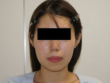 22歳女性　ベイザー頬アゴ下脂肪吸引で大人美人顔に