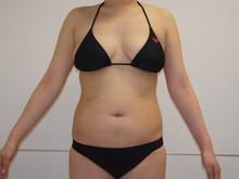 32歳女性　157㎝54㎏　80㎏まで行ったことがある方のベイザー脂肪吸引