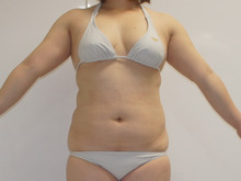 154㎝67㎏28歳女性　腹部・腰部・背中下・ワキ後ろベイザー脂肪吸引　1年後まで